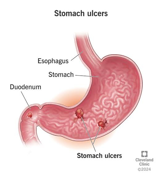 peptic-ulcer-gastroenterologist-advocates-framework-to-ensure-prompt-treatment.jpg